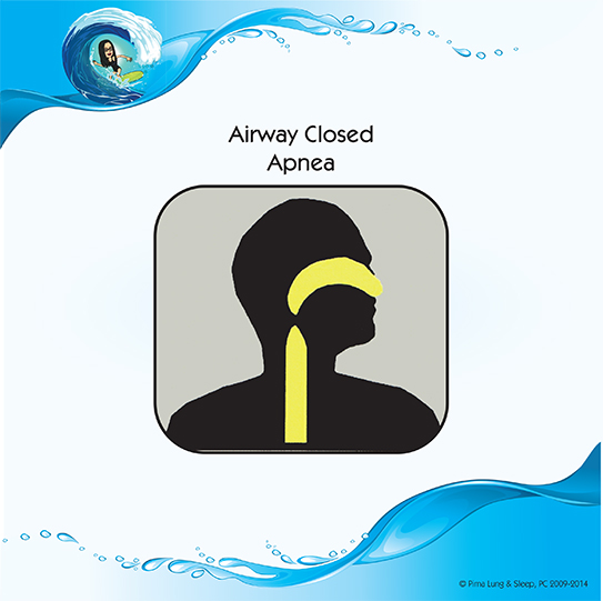 Airway Closed Apnea